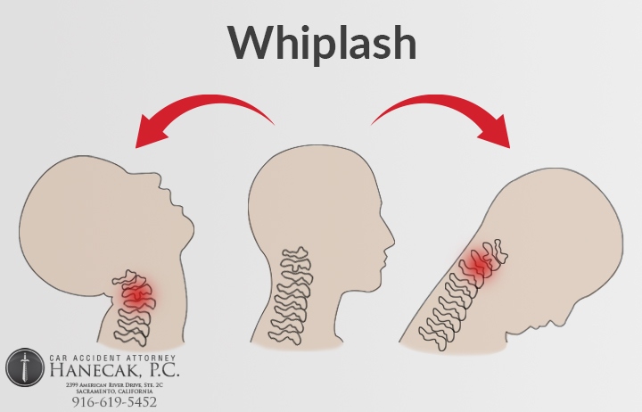 Whiplash